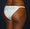 Butt Augmentation