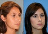 Dorsal Hump Reduction