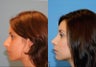 Dorsal Hump Reduction