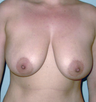 Breast Lift