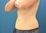 CoolSculpting