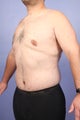 37 yr old weight loss patient