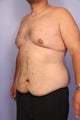 37 yr old weight loss patient