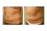 Abdominoplasty