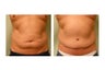 Abdominoplasty
