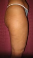 Butt Augmentation with fat grafting or Brazilian Butt Lift