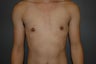 FTM. Bilateral perioareolar mastectomies, (hidden incision around nipple)
