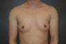 FTM. Bilateral perioareolar mastectomies, (hidden incision around nipple)
