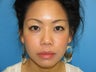 33 yr old woman using Latisse