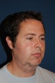 Male with Cheek/Chin Implants and Neck Lift