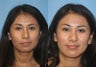 Revision Rhinoplasty