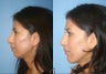 Revision Rhinoplasty