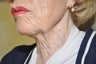 85 year old necklift