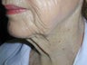 85 year old necklift