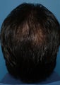 39 year old gentleman treated for hair loss in the crown