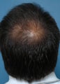 39 year old gentleman treated for hair loss in the crown