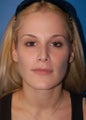 Facial Fat Grafting: Case #3