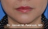 Chin Enhancement