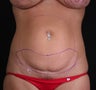 Mini Abdominoplasty