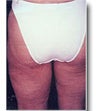 Thigh Lift