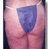 Thigh Lift
