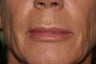 Lip Implant