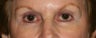 Restylane & Botox for eye rejuvenation