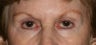 Restylane & Botox for eye rejuvenation