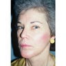 Neck Lift