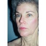 Neck Lift
