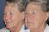Before & After IPL Photo Facial