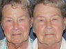 Before & After IPL Photo Facial