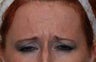 Caucasian Female Underwent Botox
