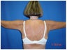 63 Year Old Female Treated for Dermatochalasis of Bilateral Upper Arms and Axillae