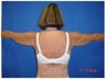 63 Year Old Female Treated for Dermatochalasis of Bilateral Upper Arms and Axillae