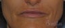 49 y/o female desired permanent lip augmentation.