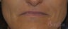 49 y/o female desired permanent lip augmentation.