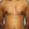 15 year Old Male Treated for Enlarged Breasts