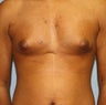15 year Old Male Treated for Enlarged Breasts