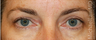 Eye Bag Surgery