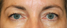 Eye Bag Surgery