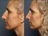 Rhinoplasty
