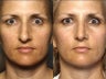 Rhinoplasty