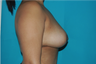 6 Month Post Operative Breast Reduction