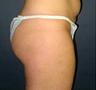 Butt Augmentation