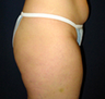 Butt Augmentation
