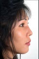 Rhinoplasty