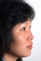 Rhinoplasty