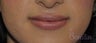 26 y/o female desired permanent lip augmentation.