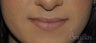 26 y/o female desired permanent lip augmentation.